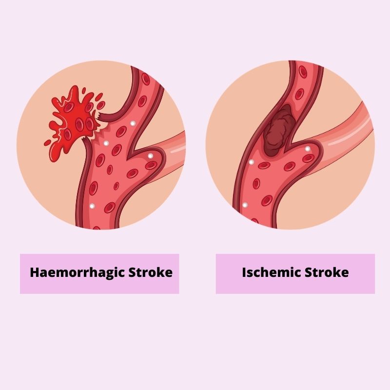 ischemic stroke and hemorrhagic stroke